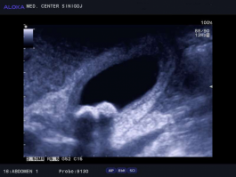 Ultrazvok žolčnika - žolčna kamna lepo vidna ultrazvočna senca